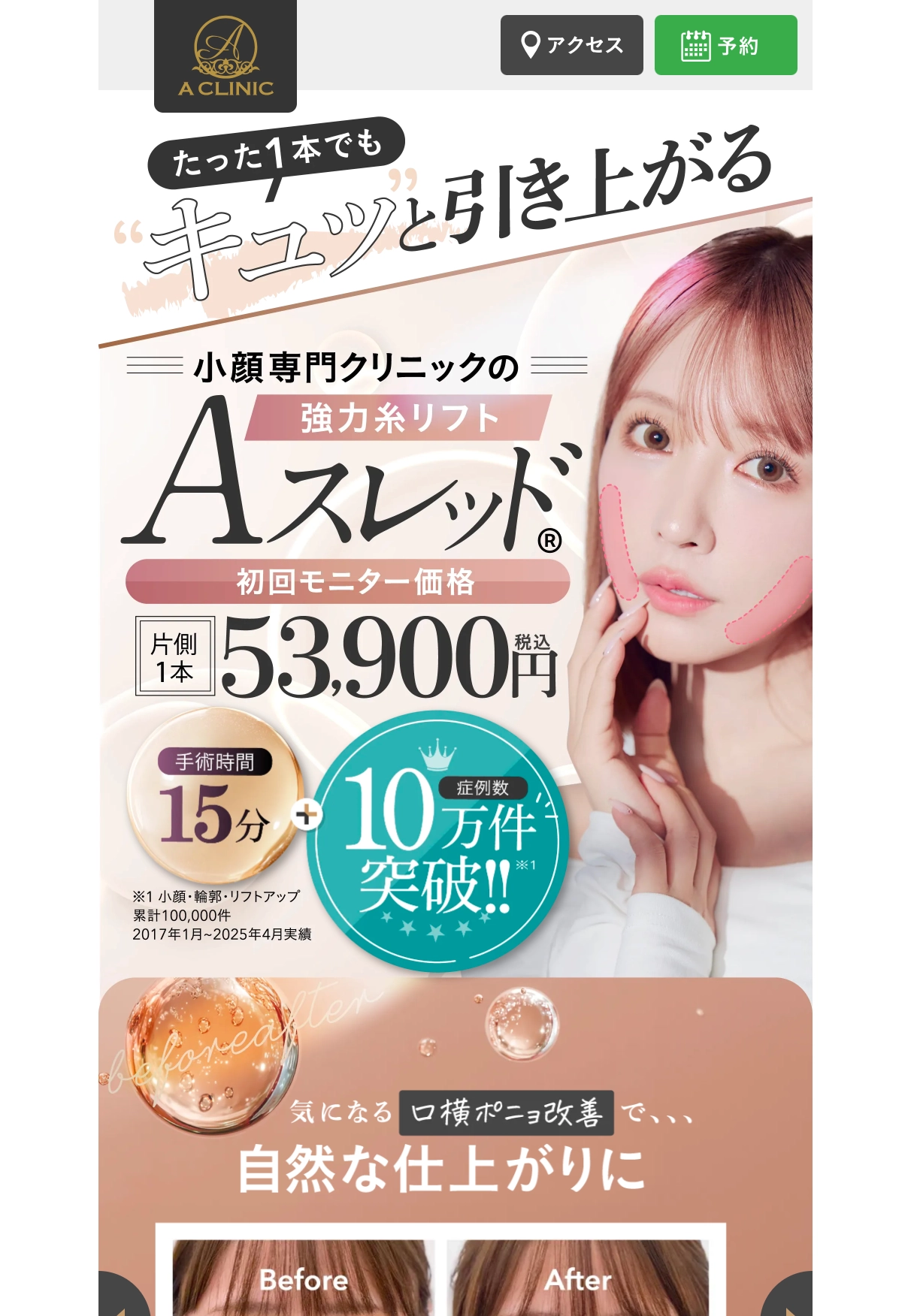 ランディングページサムネイル　Aスレッド®︎（糸リフト） | 美容整形 A CLINIC（エークリニック）の小顔術