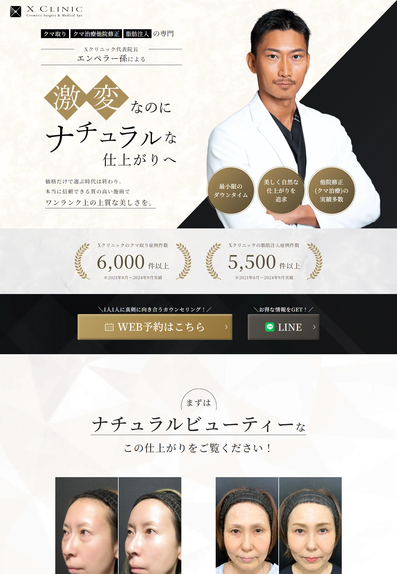 ランディングページサムネイル　クマ取り・脂肪注入 - XCLINIC代表による質の高い施術をご提供